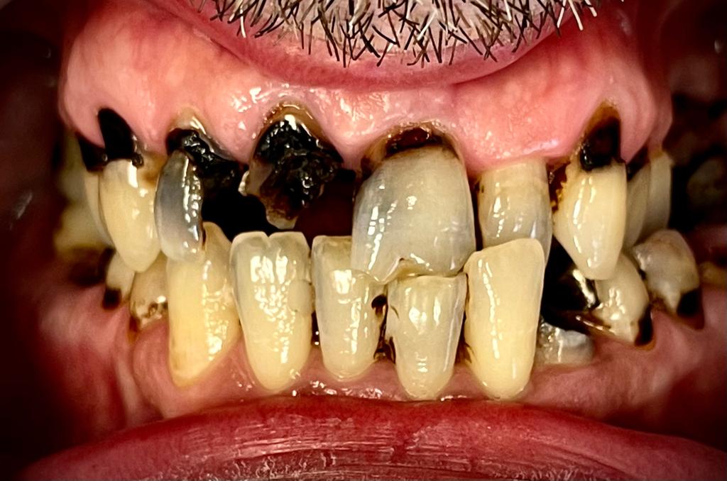 Esempio di arcata dentale superiore: situazione prima e dopo l'intervento