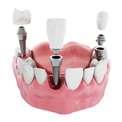 implantologia-dentale-carico-immediato