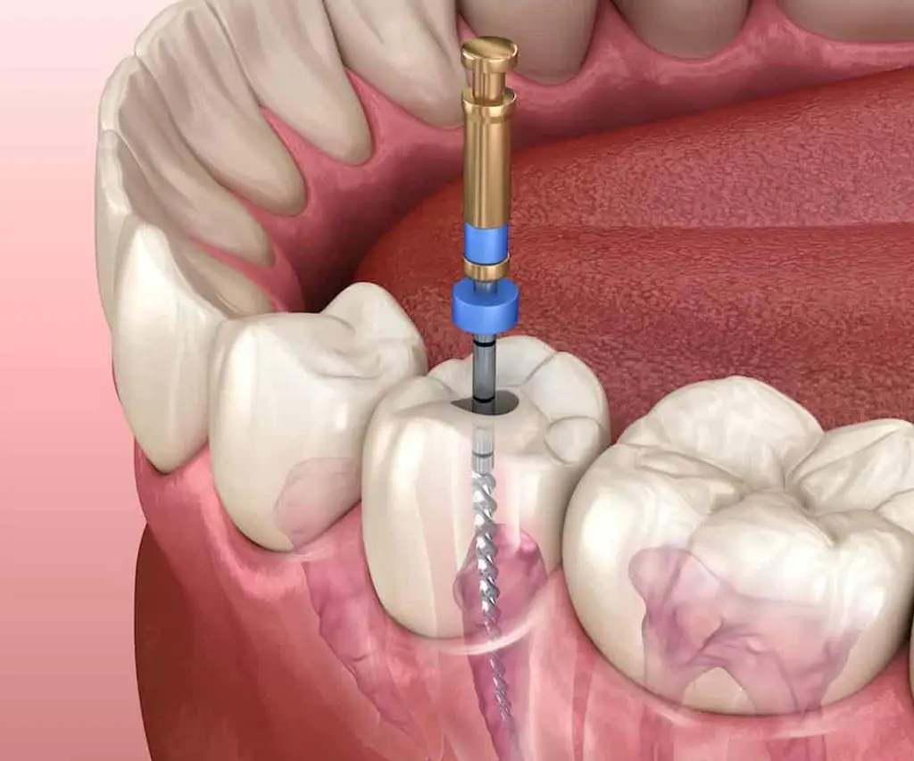 Devitalizzazione dente - Confident