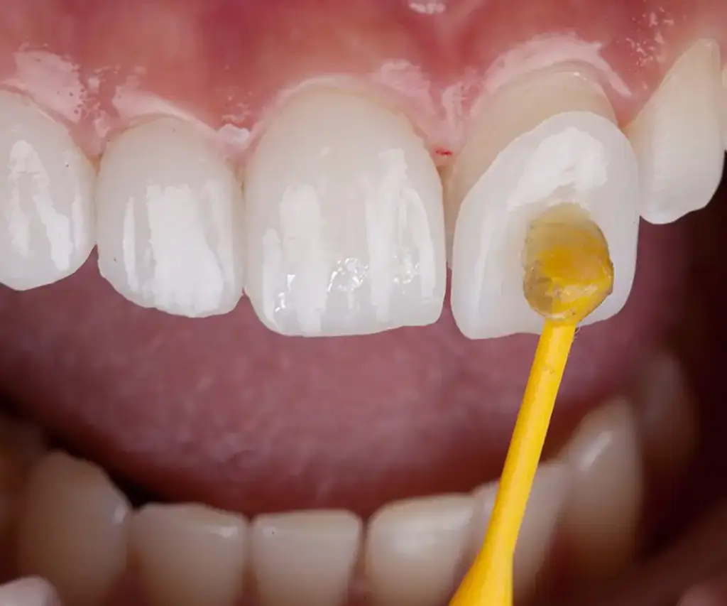 Faccette Dentali - Confident