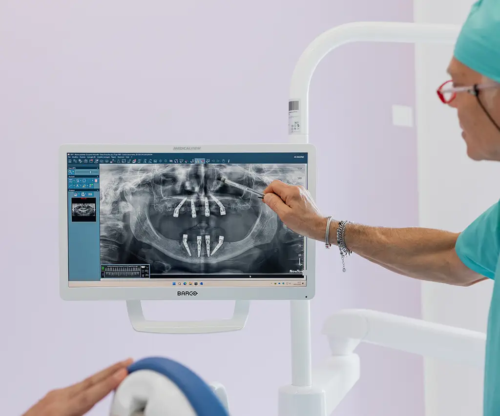 Pianificazione implantare digitale con TAC 3D per interventi precisi e sicuri Radiografia dentale con pianificazione implantare visualizzata su monitor durante consulto